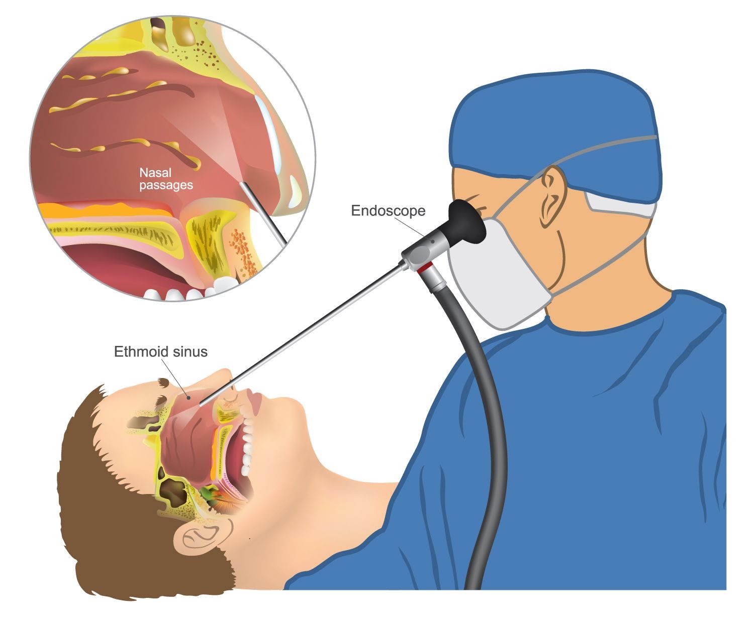 Endoscopic sinus surgery