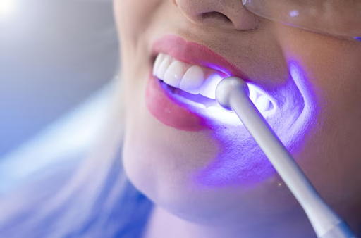 Teeth Whitening Colorado Springs: Professional Options Explained