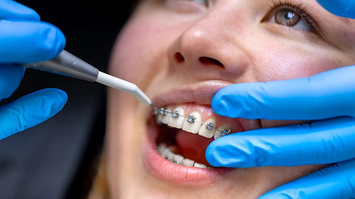 Key Considerations For Self-Ligating Braces Treatment